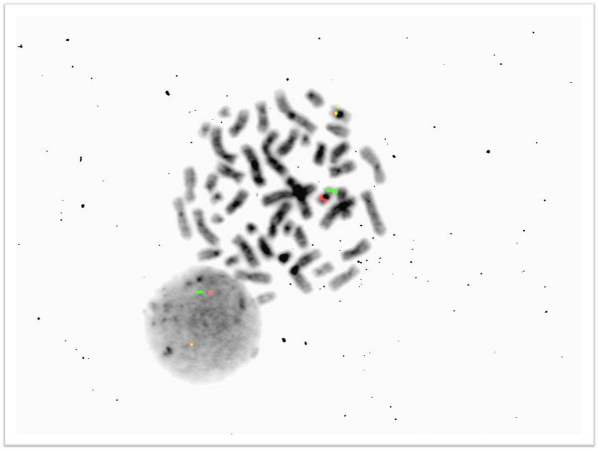 Fluorescence in situ hybridization demonstrating 1 red signal (CBFB probe), 1 green signal (MYH11 probe) and one fusion signal